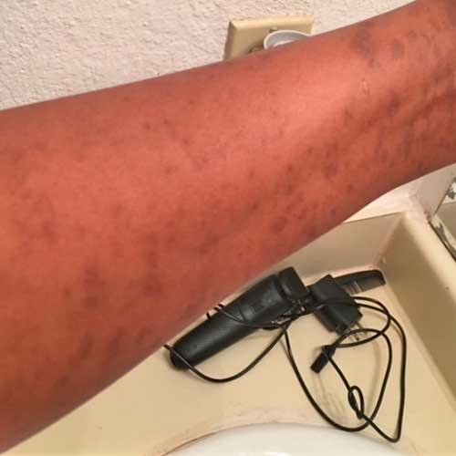 Before and After Images of Patients at Memorial Health Urgent Care and Infusions in Katy, TX