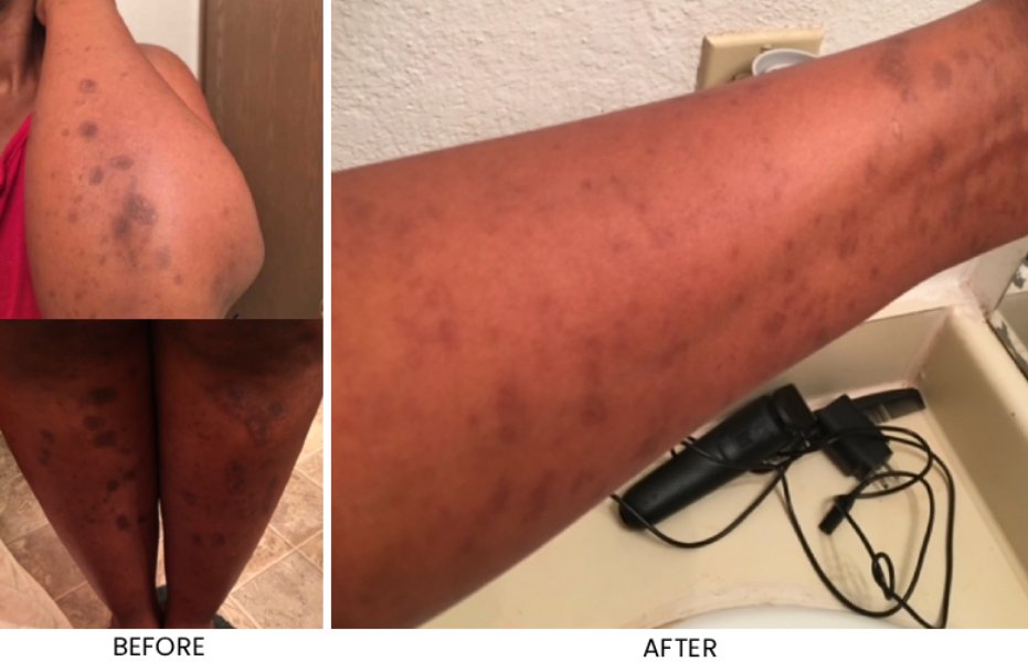 Before and After Images of Patients at Memorial Health Urgent Care and Infusions in Katy, TX